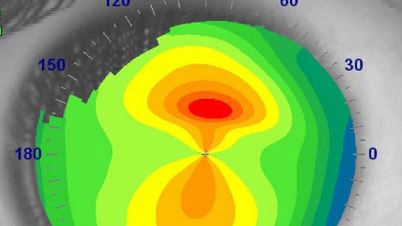 topografia corneal
